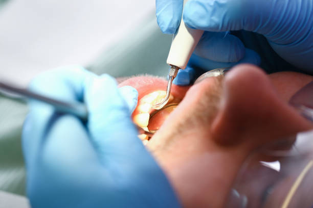Best Emergency Root Canal Treatment in Newark, NJ