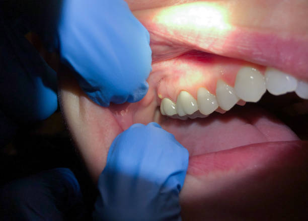 Best Emergency Wisdom Teeth Removal in Newark, NJ